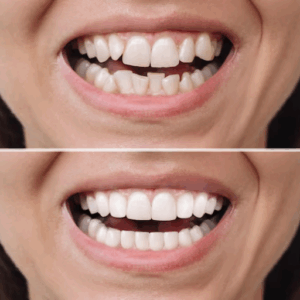 Crooked Teeth treatment near me