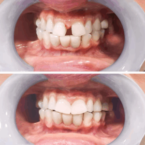 Missing Teeth treatment near me