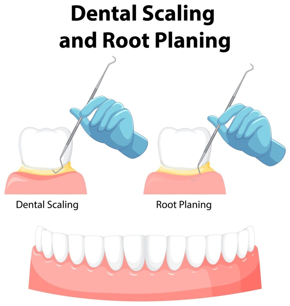 Dental Scaling & Root Planing