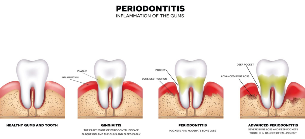 How We Assess Your Gum Health